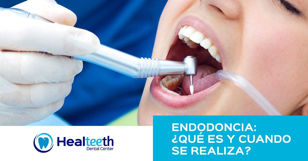 Endodoncia ¿quÉ Es Y Cuando Se Realiza